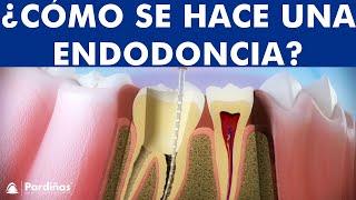 ¿Qué es una Endodoncia? - Tratamiento de conductos o desvitalización del diente paso a paso ©