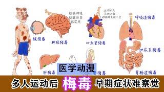 医学漫画|梅毒病因+发病机制+临床表现+诊断+有效治疗Medical comics |  syphilis|Causes 、 symptoms 、diagnosis 、 treatment