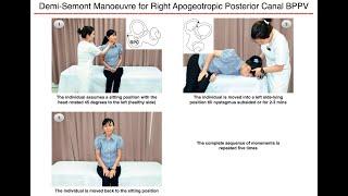 Demi-Semont Manoeuvre for Right Apogeotropic Posterior Canal BPPV