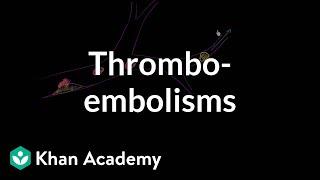 Thromboemboli and thromboembolisms | Miscellaneous | Heatlh & Medicine | Khan Academy