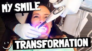 MY SMILE TRANSFORMATION!!! | JO DE LA ROSA GRAY