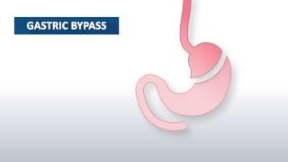 What is gastric bypass surgery? | Beaumont Health