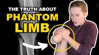 You Won’t Believe What Phantom Limb Pain is ACTUALLY Like [CC]