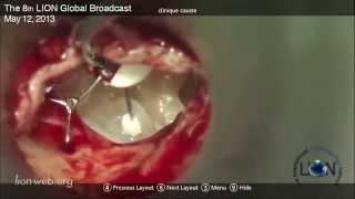 Opération de tympanoplastie en direct/Tympanoplasty live - Dr Robert Vincent