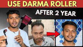 DermaRoller Effects After 2 YEAR Hair Transplant