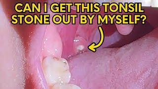 Can I Get this Tonsil Stone Out of My Throat Myself?!