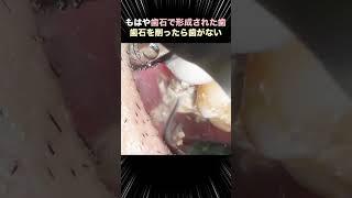 【衝撃】もはや歯石で形成された歯 #歯医者#ザホワイトデンタルクリニック #歯石除去