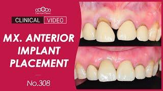 Immediate Implant placement & Restoration on Maxillary Anterior Area [Dr. Kim Jaeyoon]