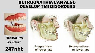 Retrognathia can also develop TMJ disorders - How do you know if you have retrognathia? | 247nht