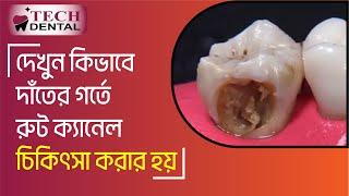 দেখুন কিভাবে দাঁতের গর্তে রুট ক্যানেল চিকিৎসা করা হয় । Root Canal Treatment procedure । Tech Dental