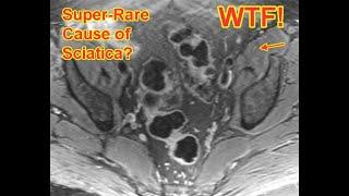 A SUPER-RARE CAUSE OF SCIATICA, CAUGHT BY MR NEUROGRAPHY?