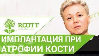  Синус - лифтинг с одновременной имплантацией, отзыв пациентки клиники ROOTT