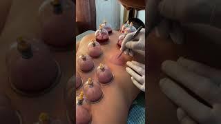 Hijama (cupping therapy)