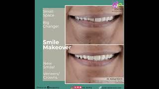 Midline Diastema| Smile Makeover| Zirconia| Veneers| Crowns| Space Closure| We Dental| Dr Arshad