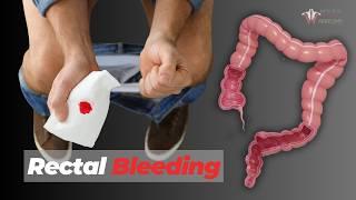 When to Be Worried About Rectal Bleeding