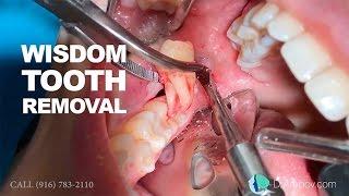 Wisdom tooth removal in 5 MIN or less. Surgical Guide: Online Course + Free e-Book!