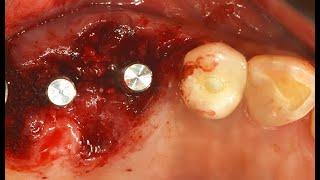 Immediate Implant Placement using BRIGHT Implant System_Dr.Strange Jang