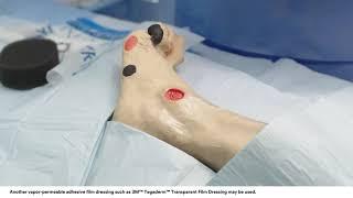 Application tips: 3M™ V.A.C.® Dressing Application Bridging Technique on Foot Wound