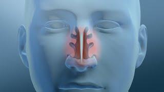 Nasal Turbinate Reduction