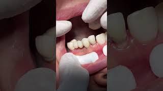 Fixed bridge #dentist #dental