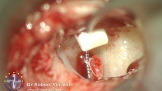 Revision tympanoplasty for lateralized graft with dislocated malleus. Dr Robert Vincent