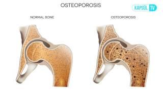 Osteoporoz (Kemik Erimesi) Nedir?