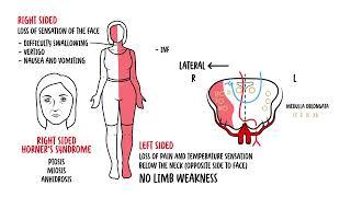 Medulla Oblongata Syndromes - Medial and Lateral Medullary Syndrome, Medullary Lesions