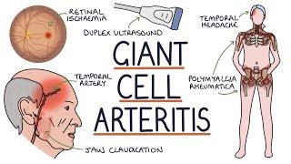 Understanding Giant Cell Arteritis (Temporal Arteritis)