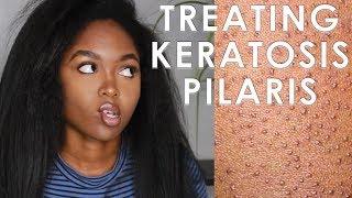 TREATING KERATOSIS PILARIS - 3 EASY STEPS