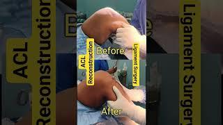 ACL Ligament BEFORE  AFTER #aclinjury #aclrecovery #ligament #ligamenttear #kneeligament #ligament