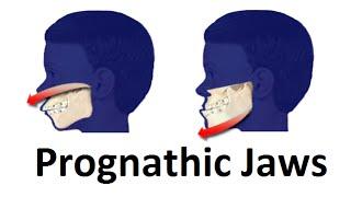 Treatment of Prognathic Jaw (Jaw Pushing Forward) by Prof John Mew