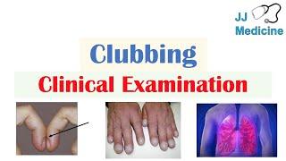 Clubbing (Fingers & Toes) | Causes, Schamroth’s Sign, Associated Conditions, Treatment