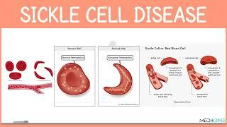 Sickle cell Disease Simplified