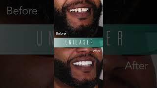 Unique experience #bondingveneers #dentist #smiledentist #smile #perfectsmileveneers #colombia