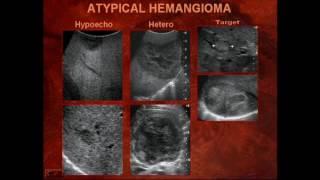 Sonography of Liver Masses