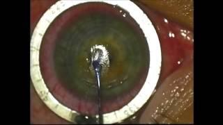 Lenticule removal, part 1 of 2