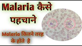 malaria parasite I Plasmodium vivax under microscope I malaria positive report