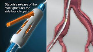 JOTEC E-liac Stent Graft System