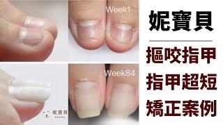 Corrective example of severe biting of the finger - nail ultra-short nail bed atrophy refers to