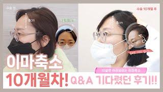 The review of the 10th month of the forehead reduction surgery, the oriental doctor received