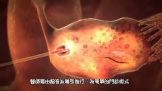 試管嬰兒 (IVF) : 認識試管嬰兒、試管嬰兒流程