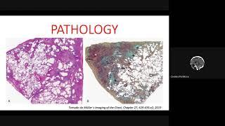 USUAL INTERSTITIAL PNEUMONIA