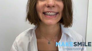 Брекеты - это модно! Цветные лигатуры на брекеты в MAKESMiLE