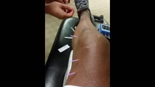 Dry Needling Session@Foothills Physical Therapy Clinic in Phoenix, Arizona