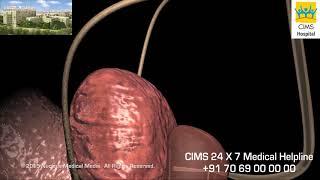 Transurethral Resection of the Prostate (TURP) - CIMS Hospital