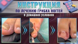 Инструкция по лечению грибка ногтей в домашних условиях
