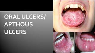 Oral Ulcers | How To Get Rid Of Oral Ulcers | Oral Ulcer Treatment