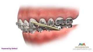 Orthodontic Treatment for Overjet (Overbite) - Rubber Bands