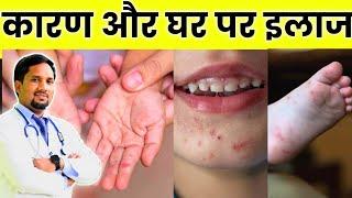 बच्चों के हाथ पैरों मुँह पर निकलने वाले दाने Hand foot mouth disease