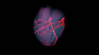 Distal LAD stenosis